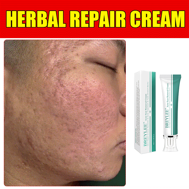 [Awarded International Award for Acne Scar Removal] Herbal Acne Scar Removal Repair Cream