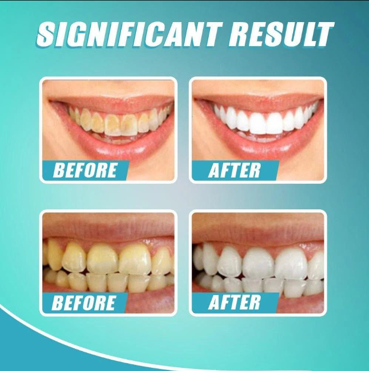 Intensive Stain Removal Whitening Toothpaste【🚚CASH ON DELIVERY + LOCAL STOCK (EXPRESS 3 DAY DELIVERY)】 TO2