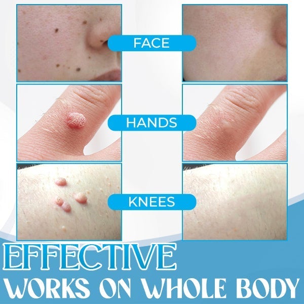 Auto-Micro Skin Tag Remover【Maha Shivaratri/Holi Offer-40%】
